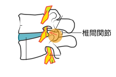 ぎっくり腰の説明画像